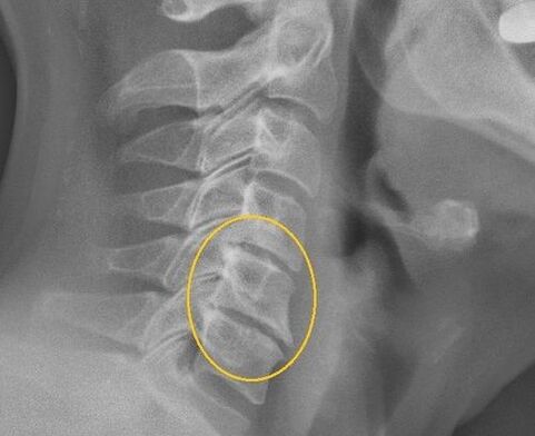 Osteocondrose da columna cervical nunha x raios