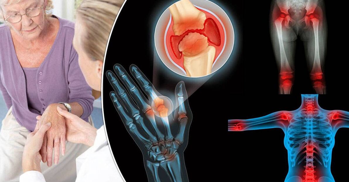 Que é a osteoartrite